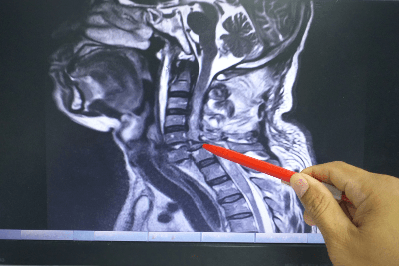 mri of a neck injury